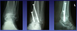 Arthrodesis