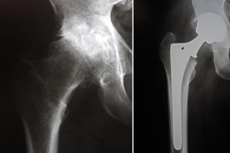 Hip Replacement Surgery