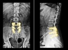Spinal Fusion